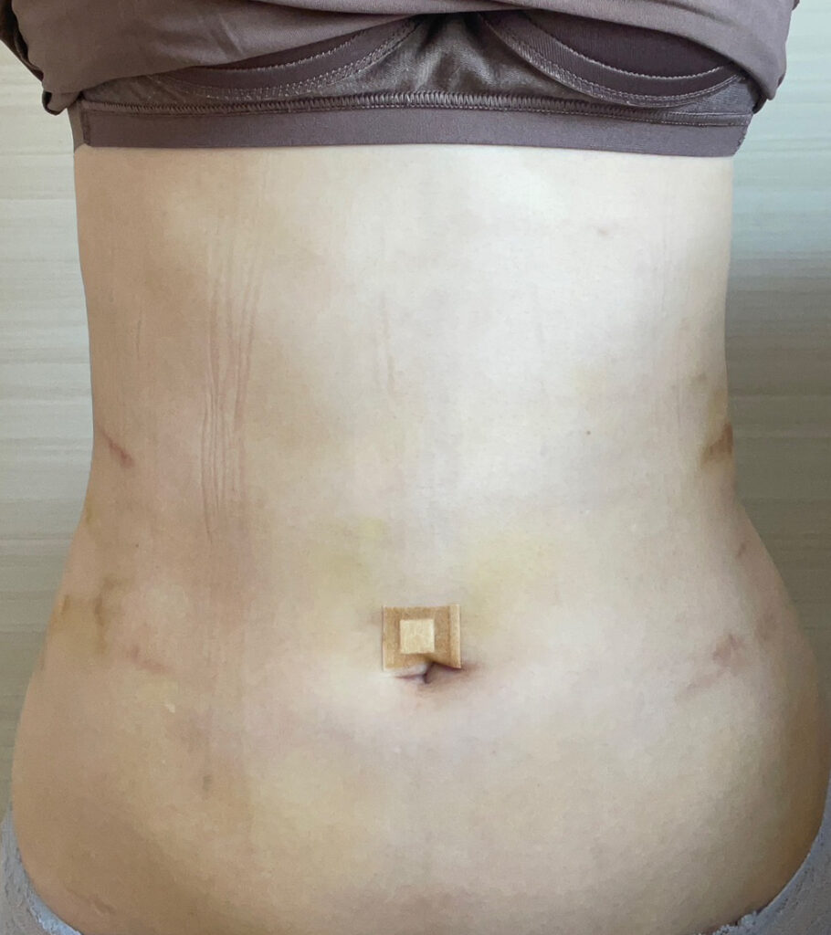 お腹の脂肪吸引