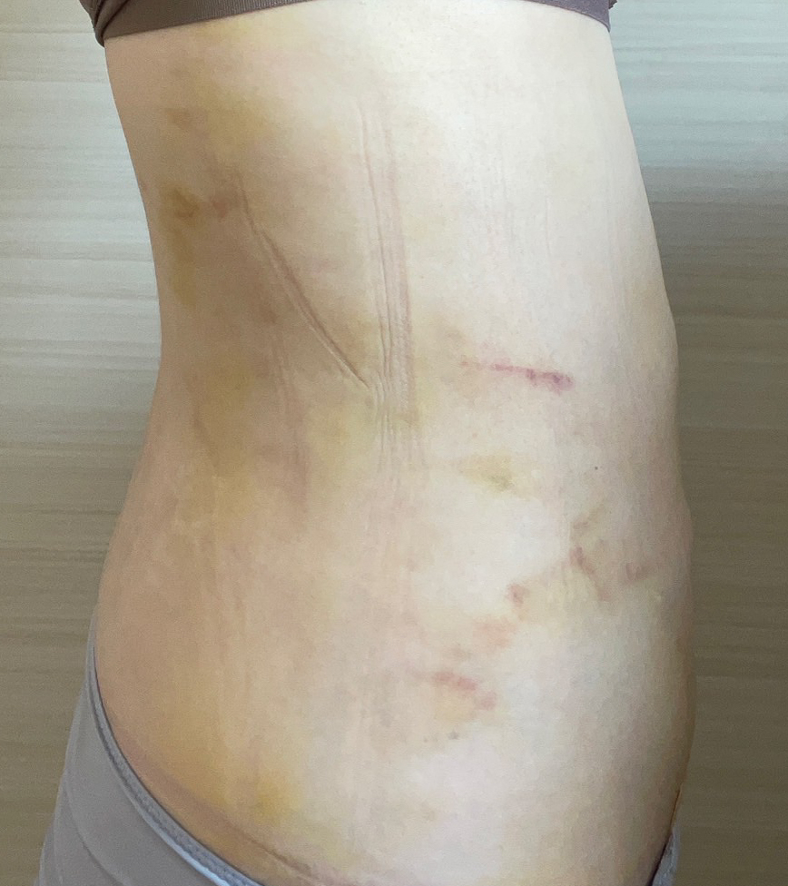 お腹の脂肪吸引