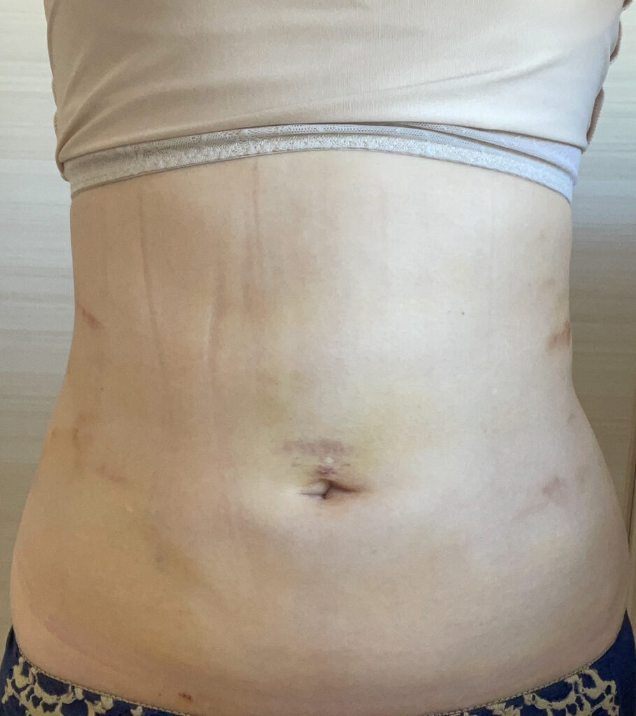 お腹の脂肪吸引