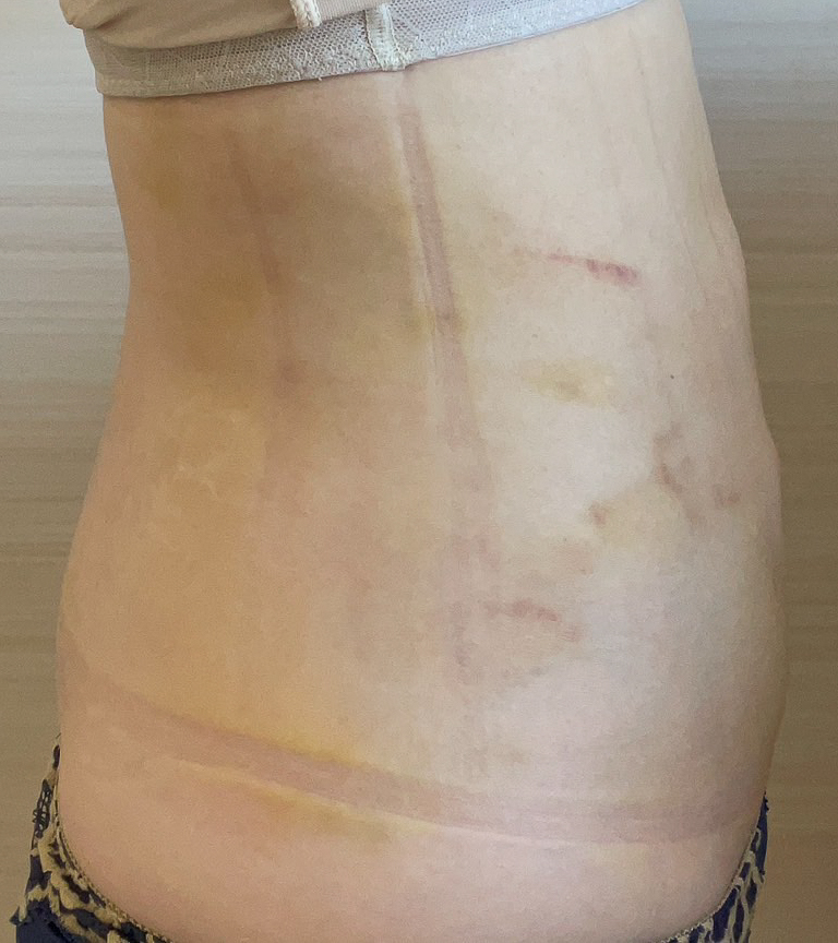 お腹の脂肪吸引