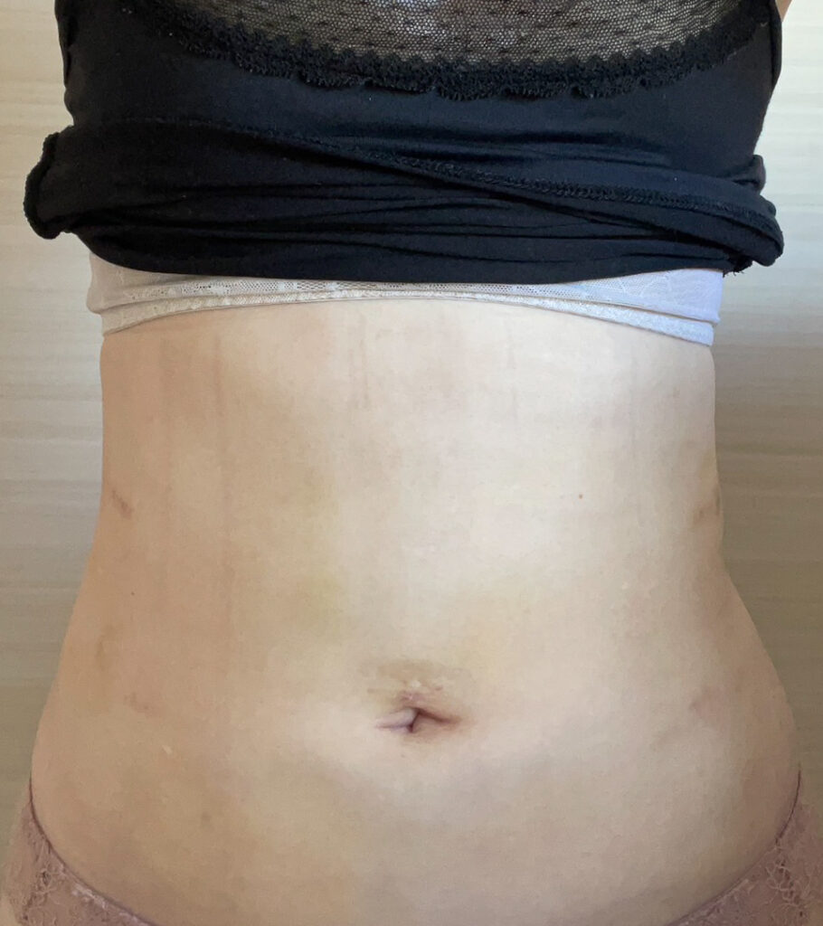 お腹の脂肪吸引