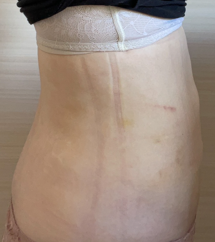 お腹の脂肪吸引