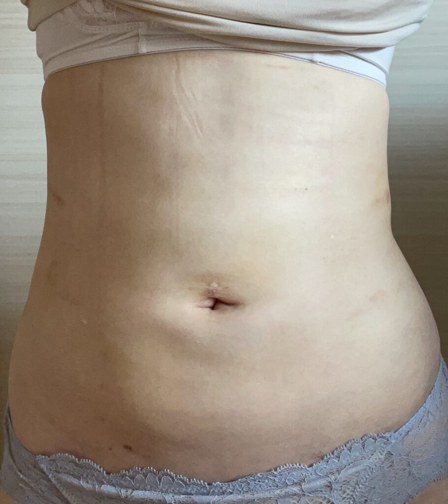 お腹の脂肪吸引