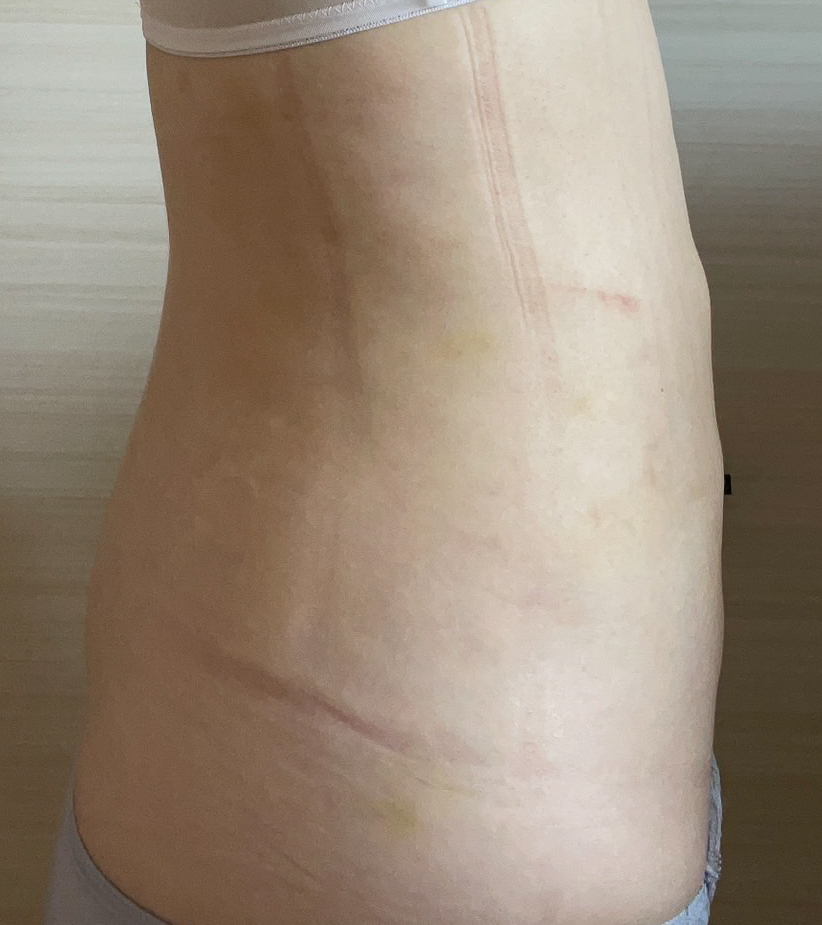 お腹の脂肪吸引