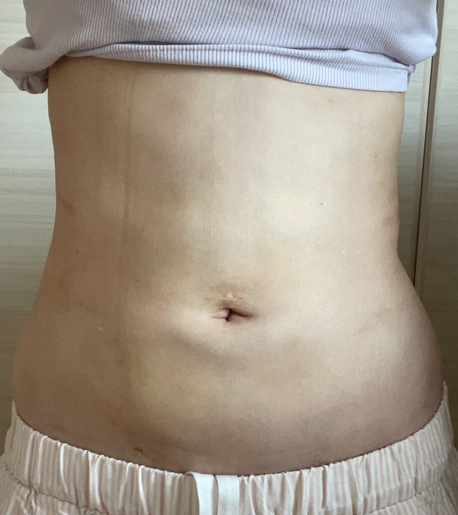 お腹の脂肪吸引