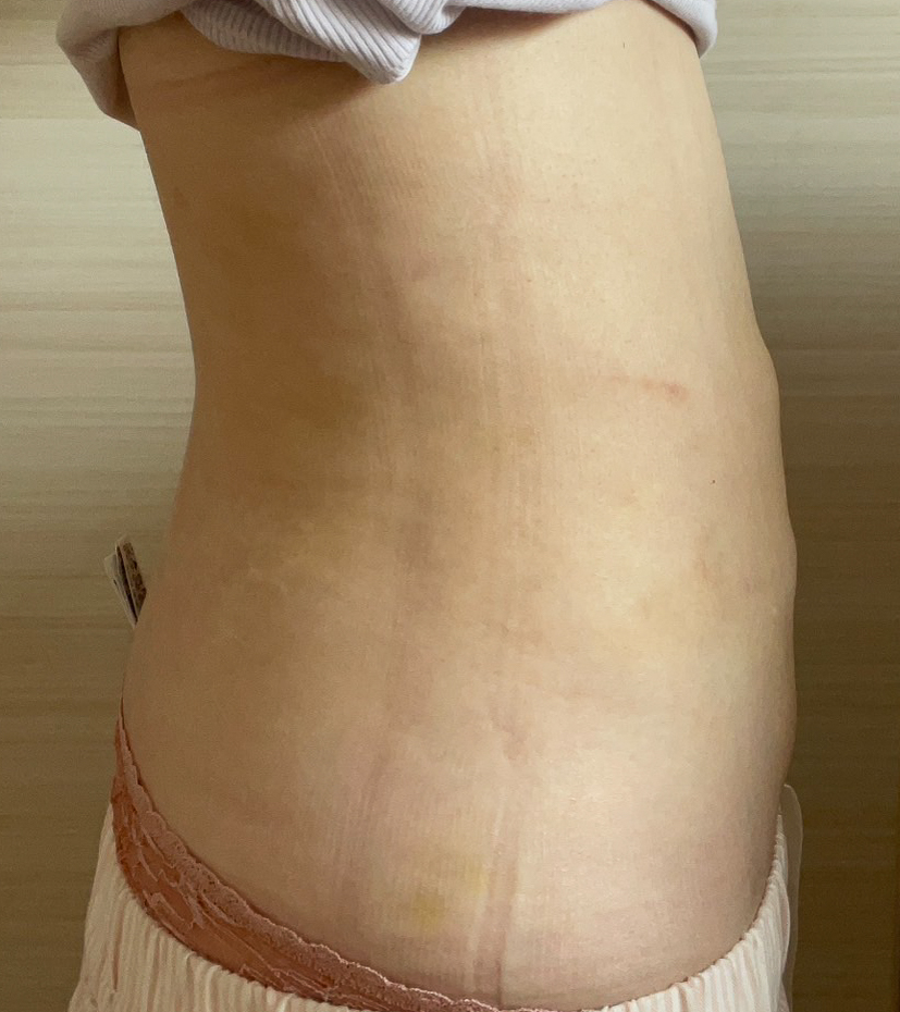 お腹の脂肪吸引