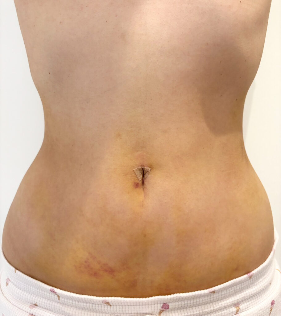 お腹の脂肪吸引