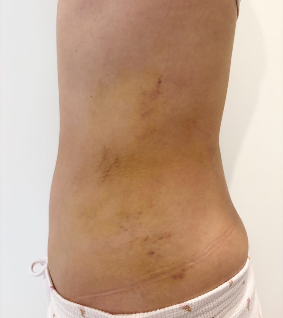 お腹の脂肪吸引