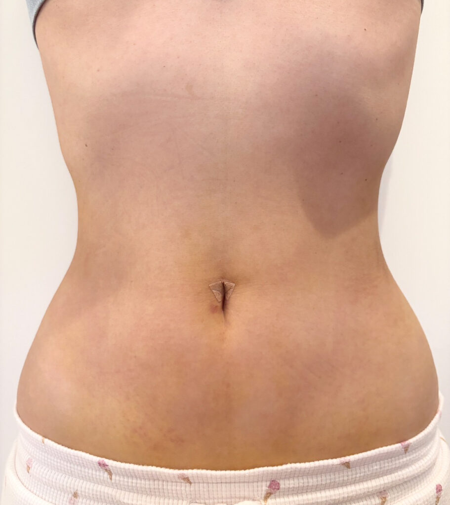 お腹の脂肪吸引