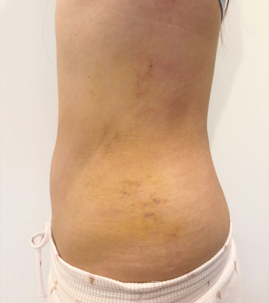 お腹の脂肪吸引