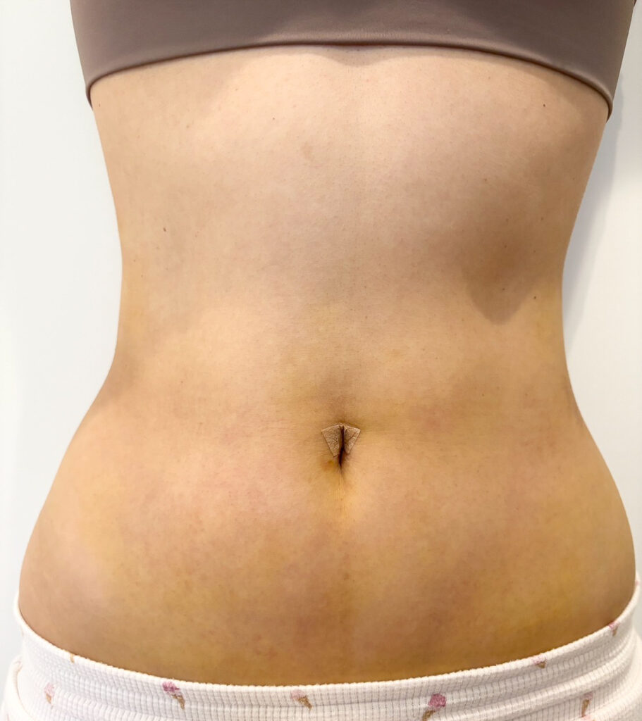 お腹の脂肪吸引