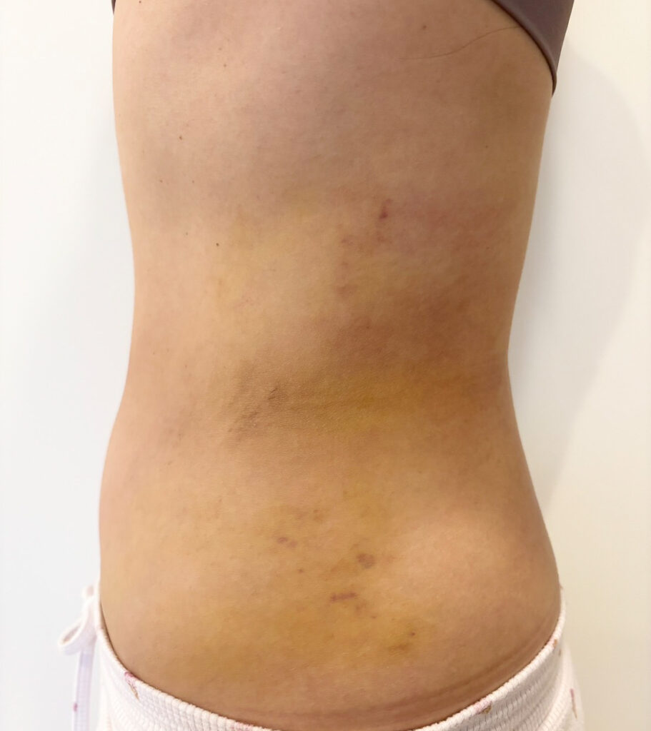 お腹の脂肪吸引