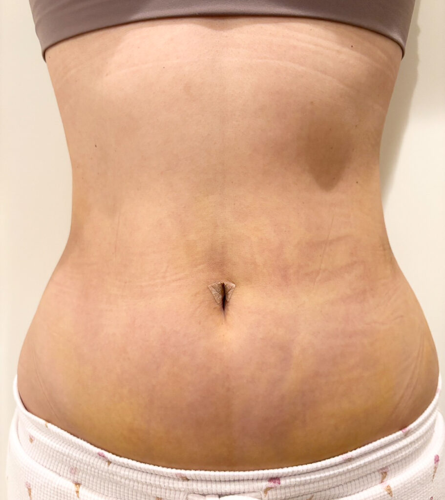 お腹の脂肪吸引