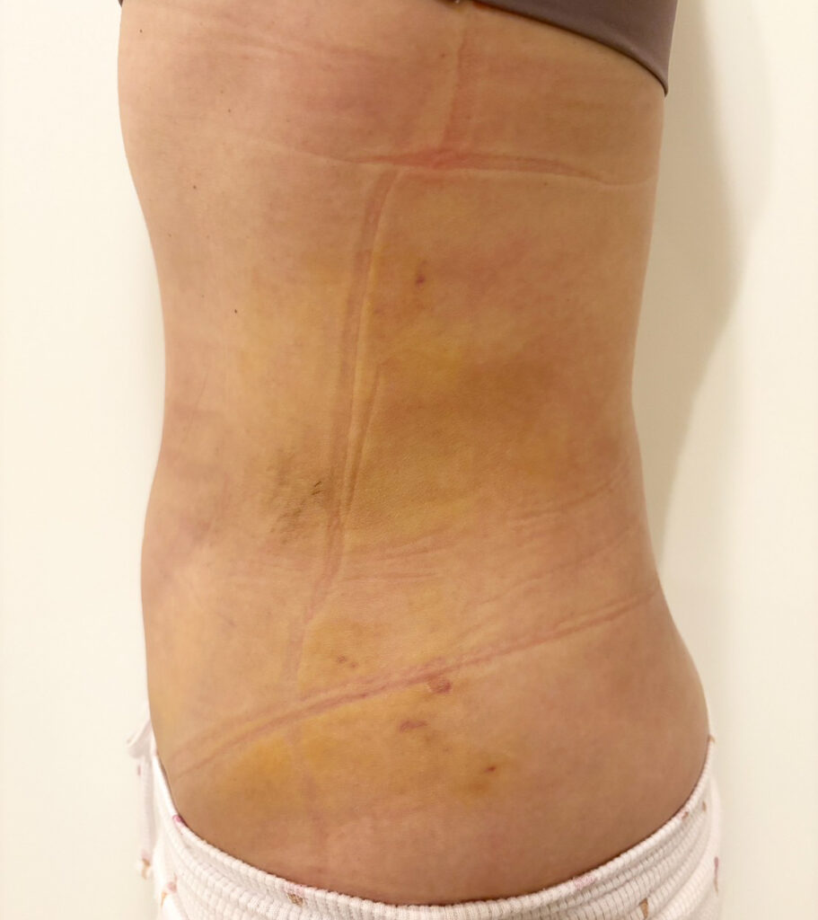 お腹の脂肪吸引