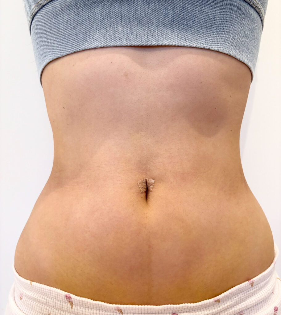 お腹の脂肪吸引