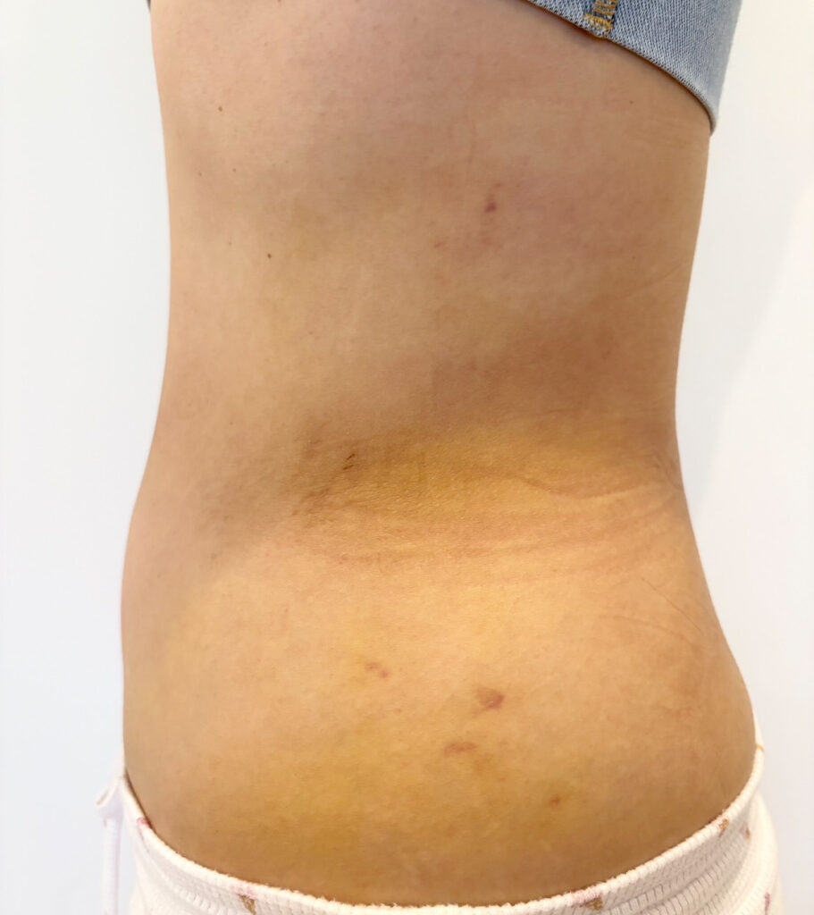 お腹の脂肪吸引