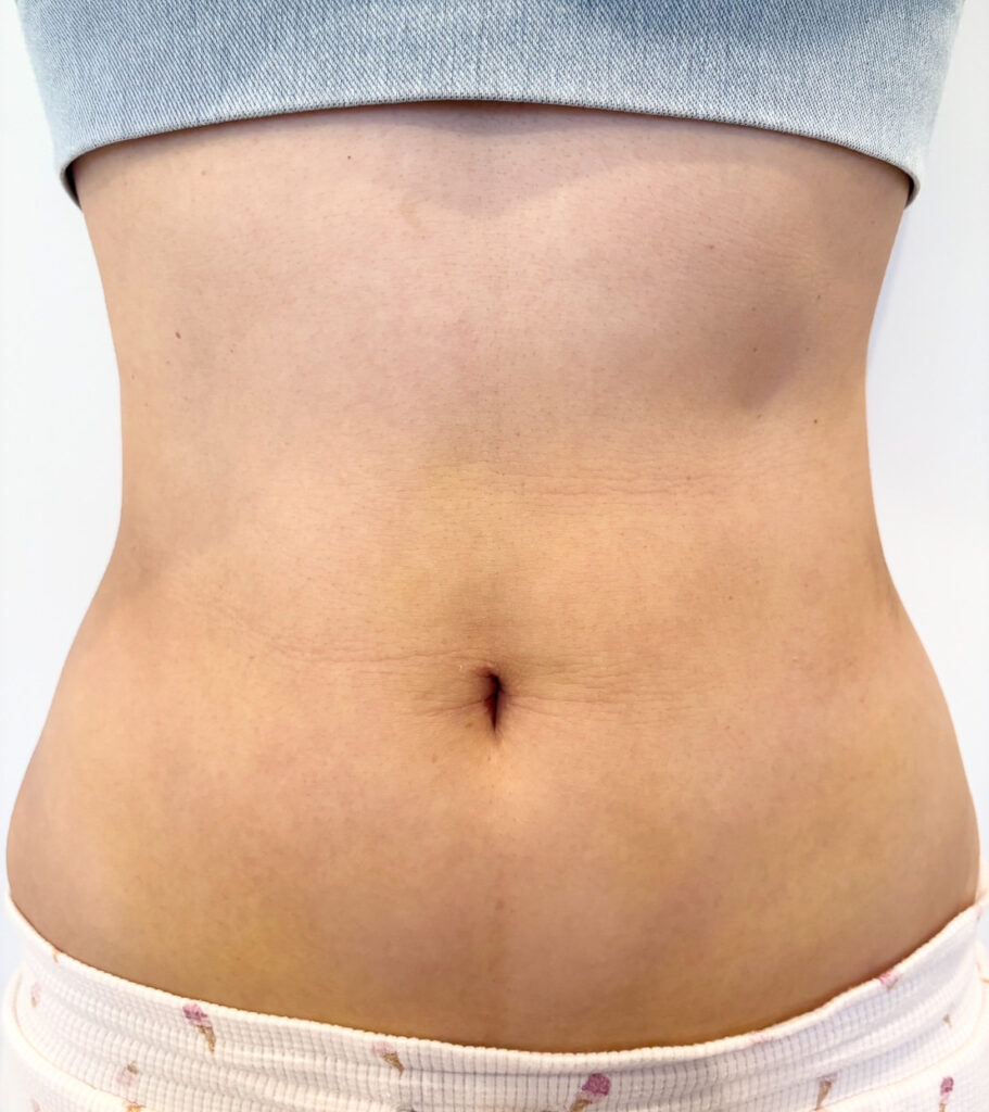 お腹の脂肪吸引