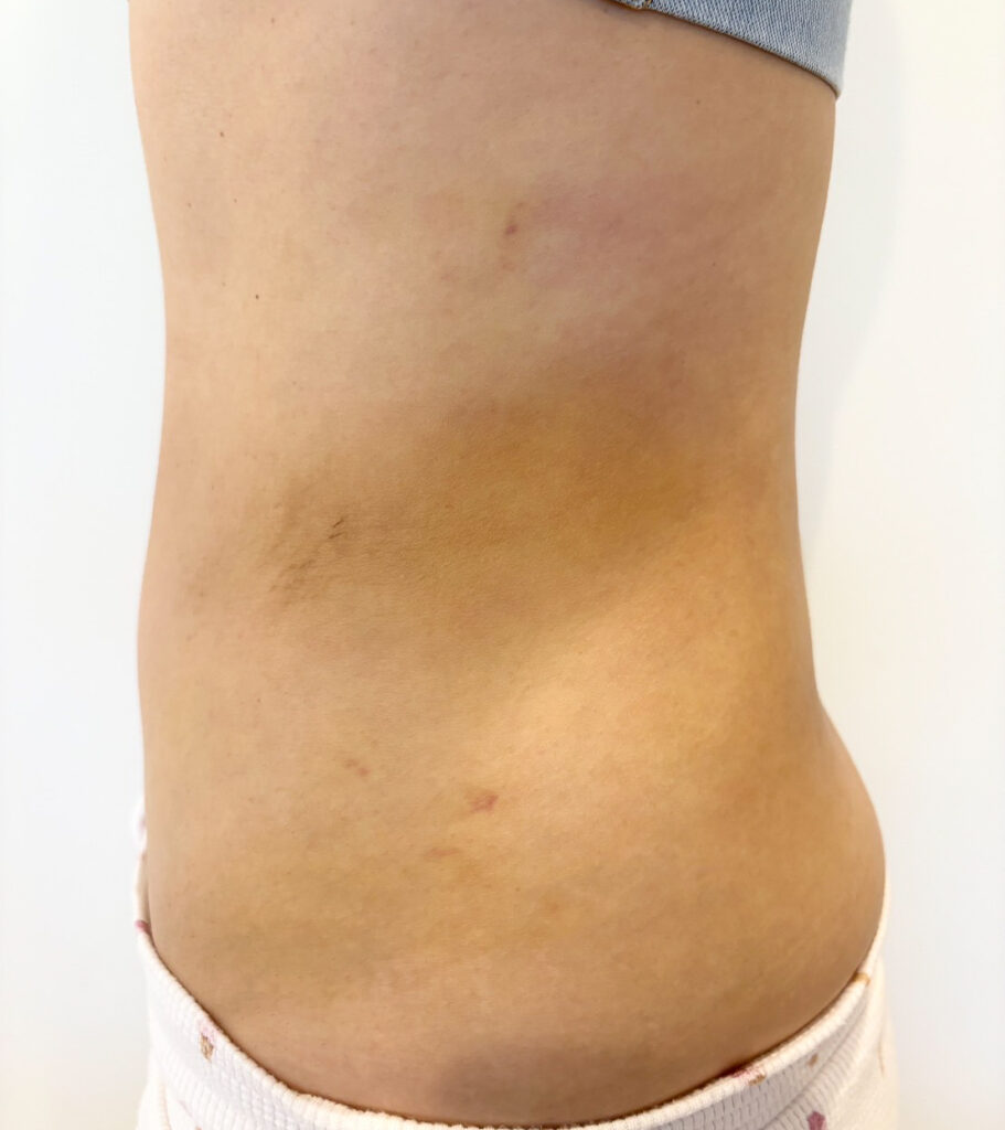 お腹の脂肪吸引