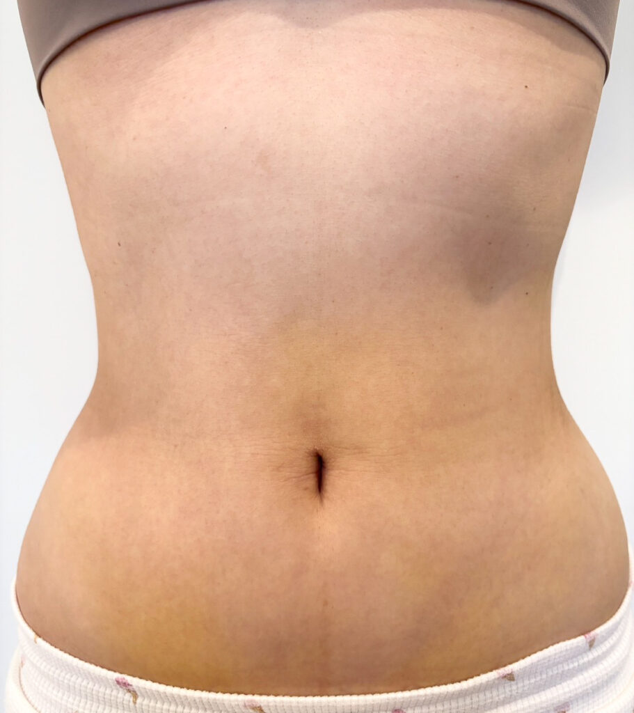 お腹の脂肪吸引