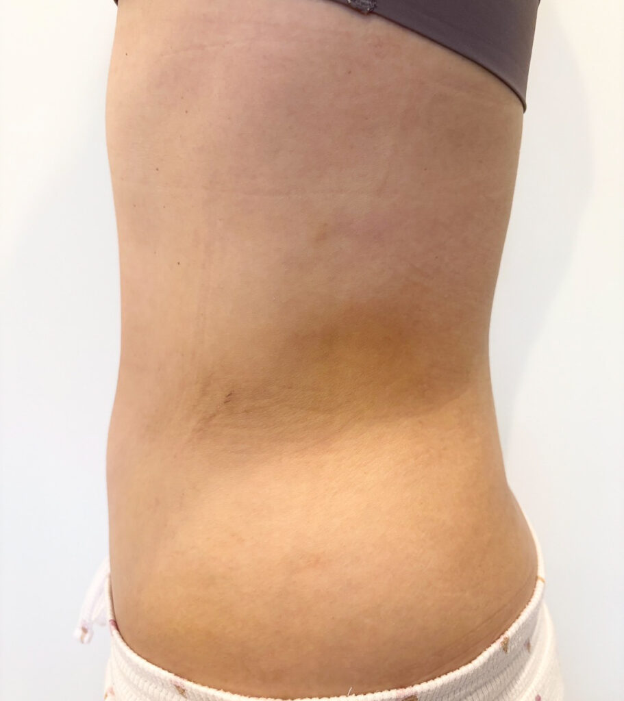 お腹の脂肪吸引