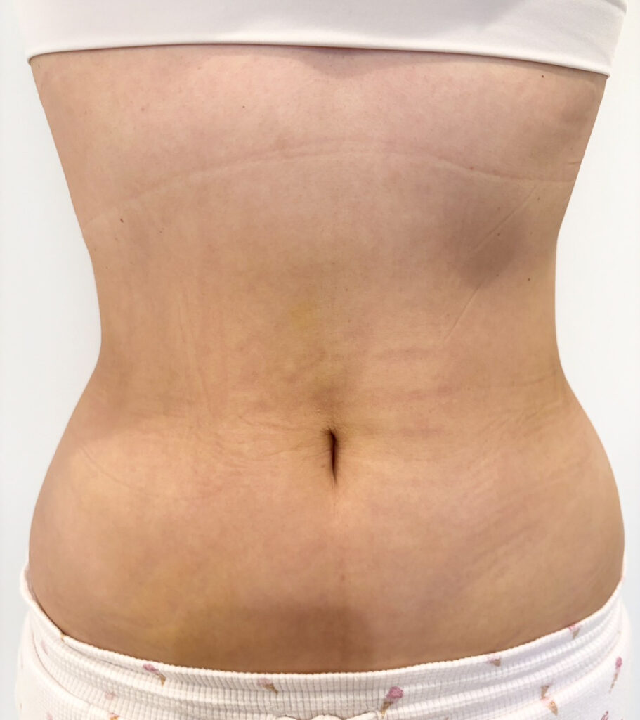 お腹の脂肪吸引