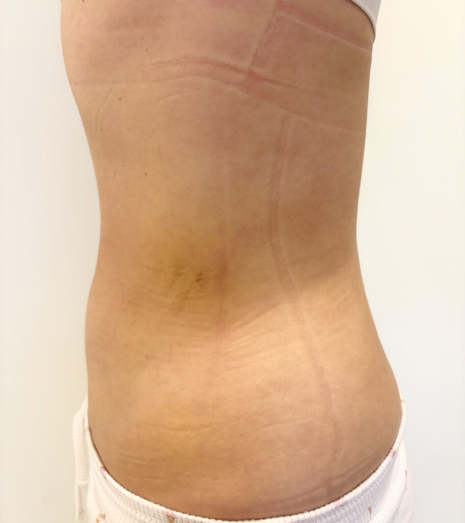 お腹の脂肪吸引