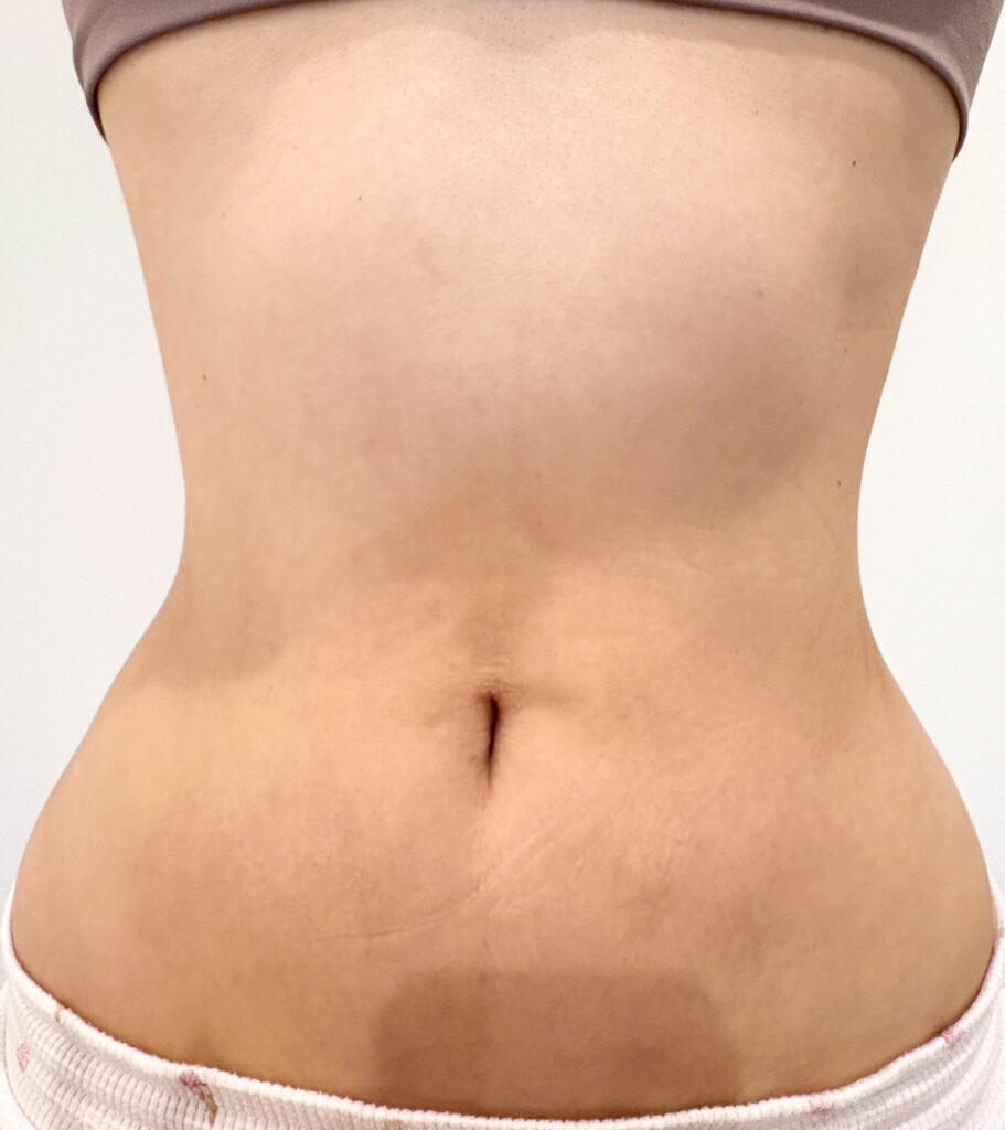 お腹の脂肪吸引