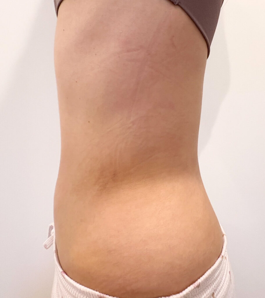 お腹の脂肪吸引