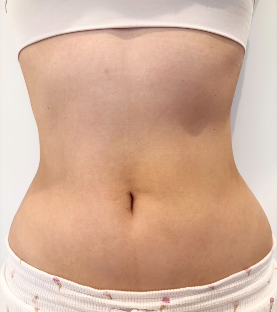 お腹の脂肪吸引