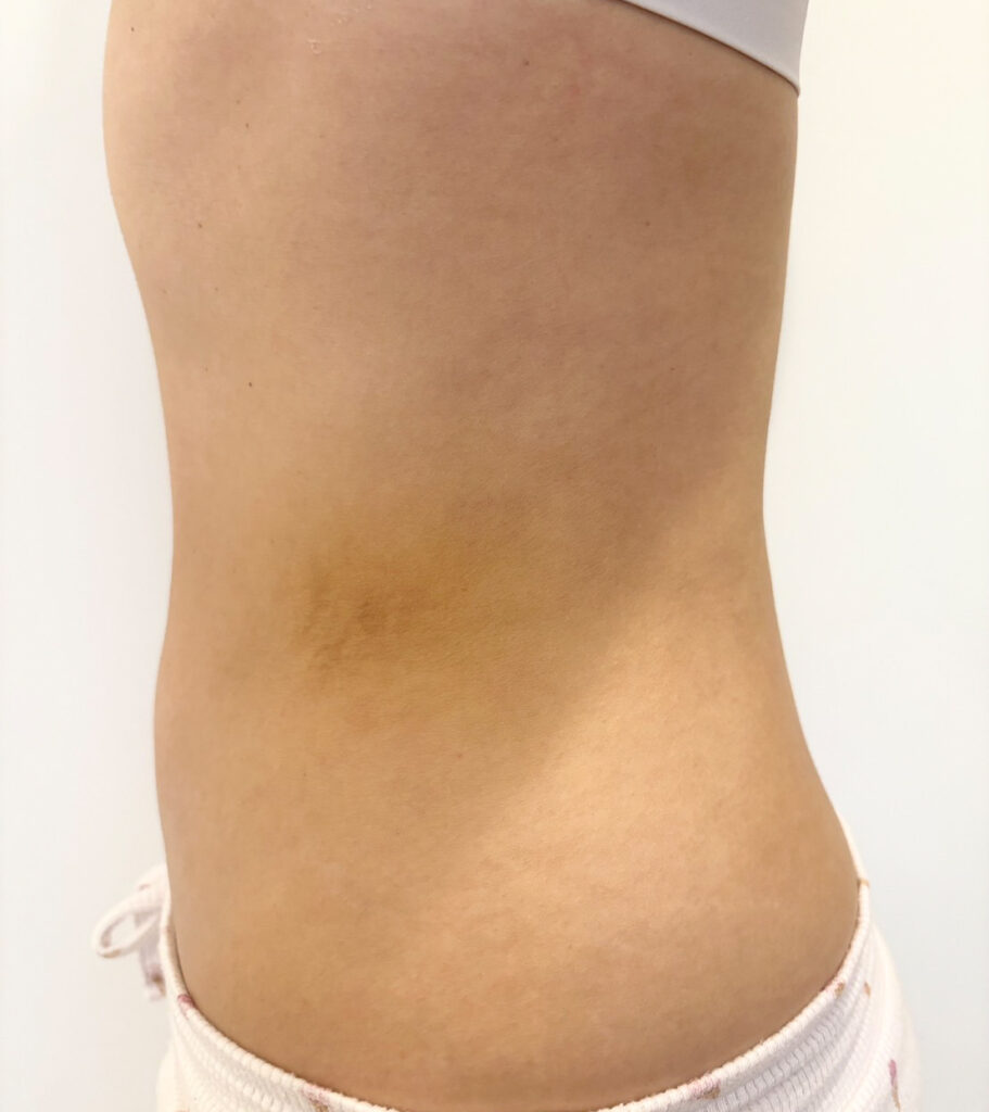 お腹の脂肪吸引