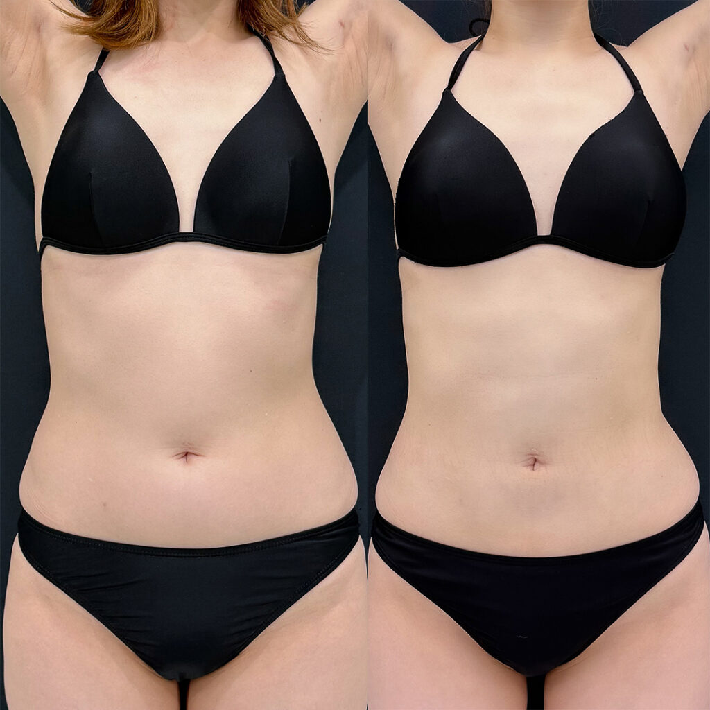 お腹の脂肪吸引