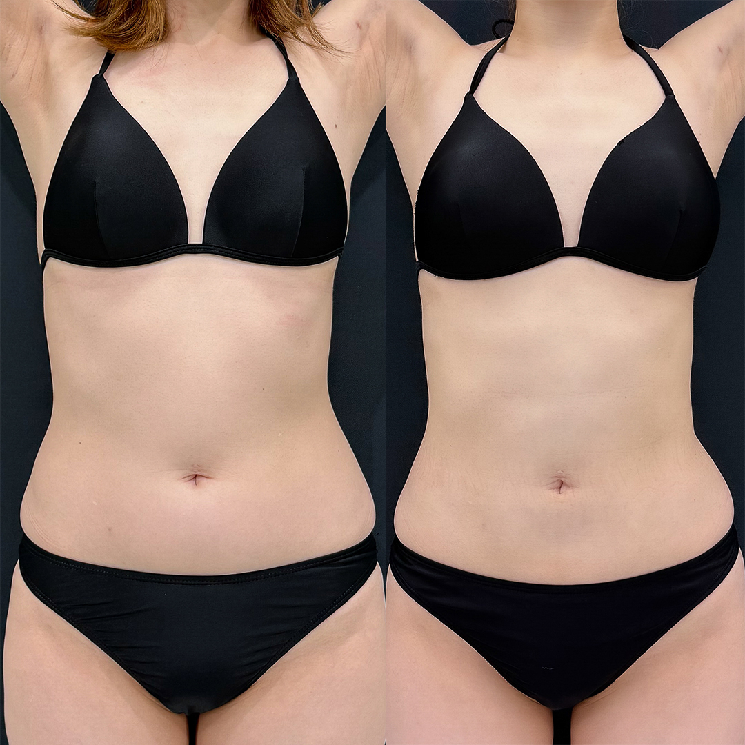 お腹の脂肪吸引