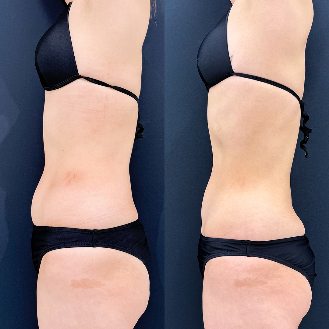 https://purelys-tokyo-clinic.com/wp/wp-content/uploads/2025/11/Before-and-After-abdominal-Liposuction_Case-No.151.jpg