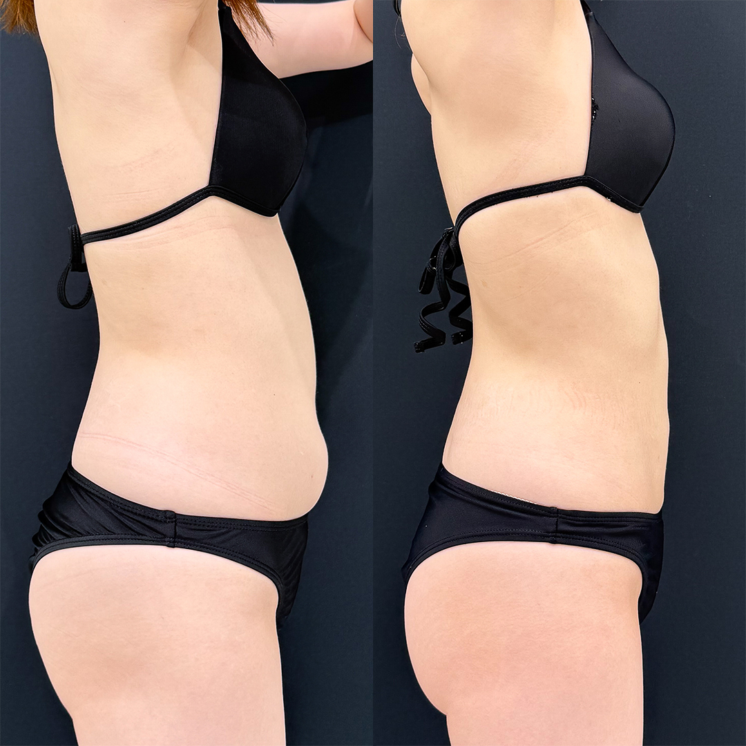 https://purelys-tokyo-clinic.com/wp/wp-content/uploads/2025/11/Before-and-After-abdominal-Liposuction_Case-No.152.jpg
