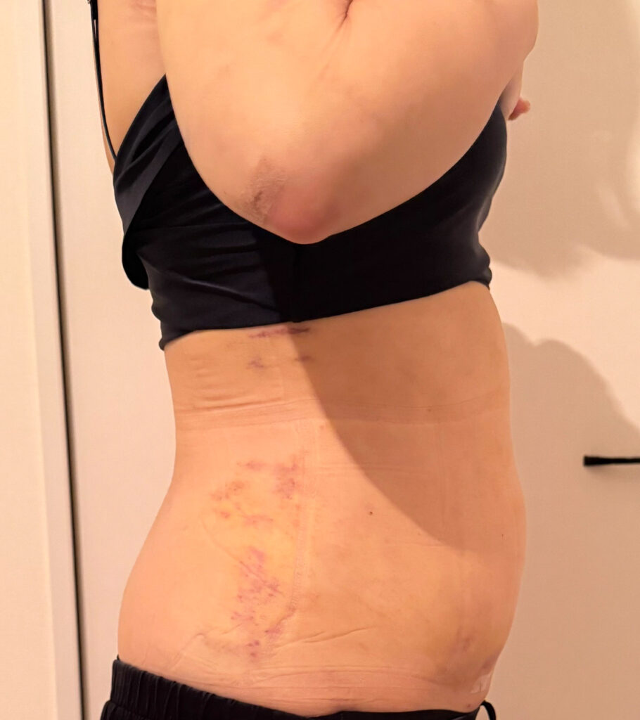 お腹の脂肪吸引