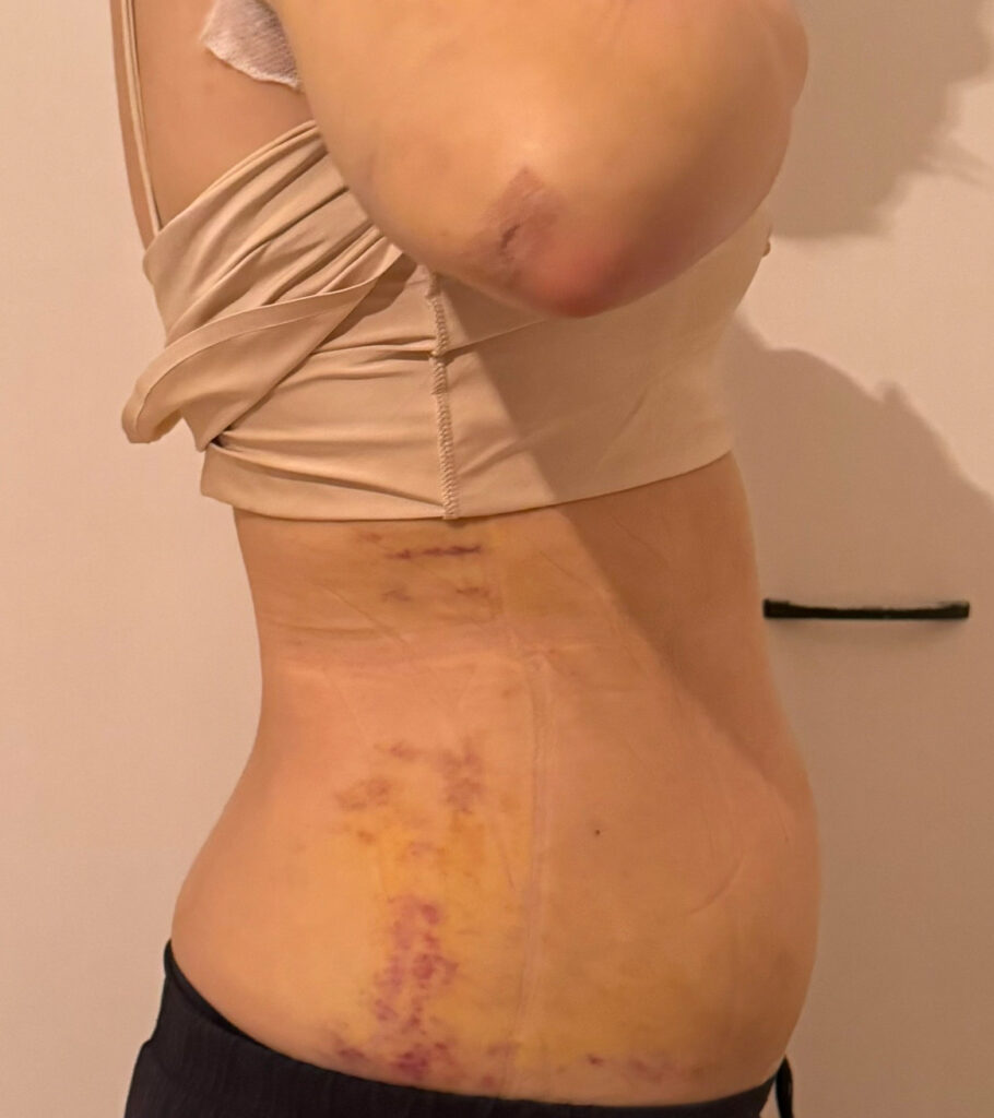 お腹の脂肪吸引