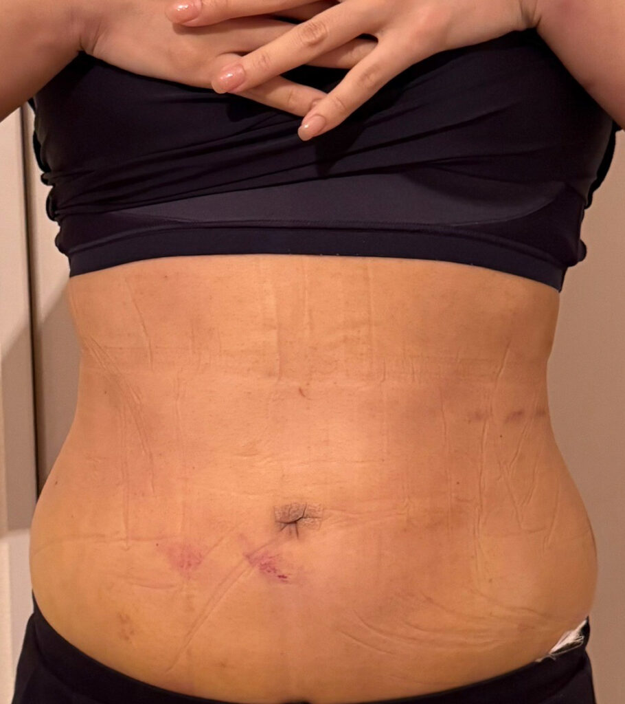 お腹の脂肪吸引