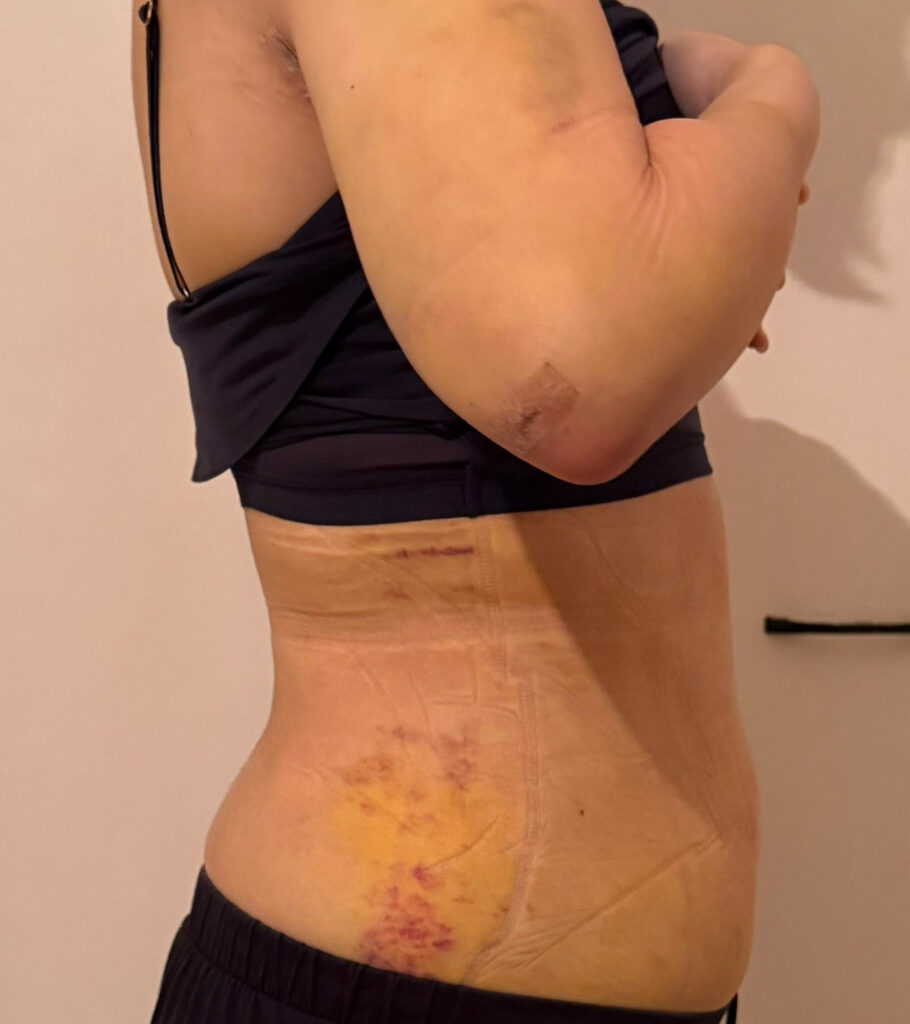 お腹の脂肪吸引