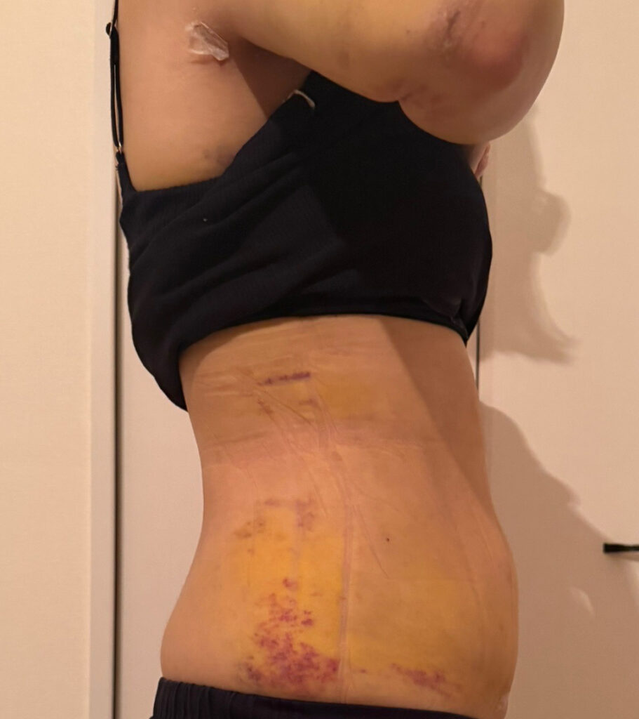 お腹の脂肪吸引