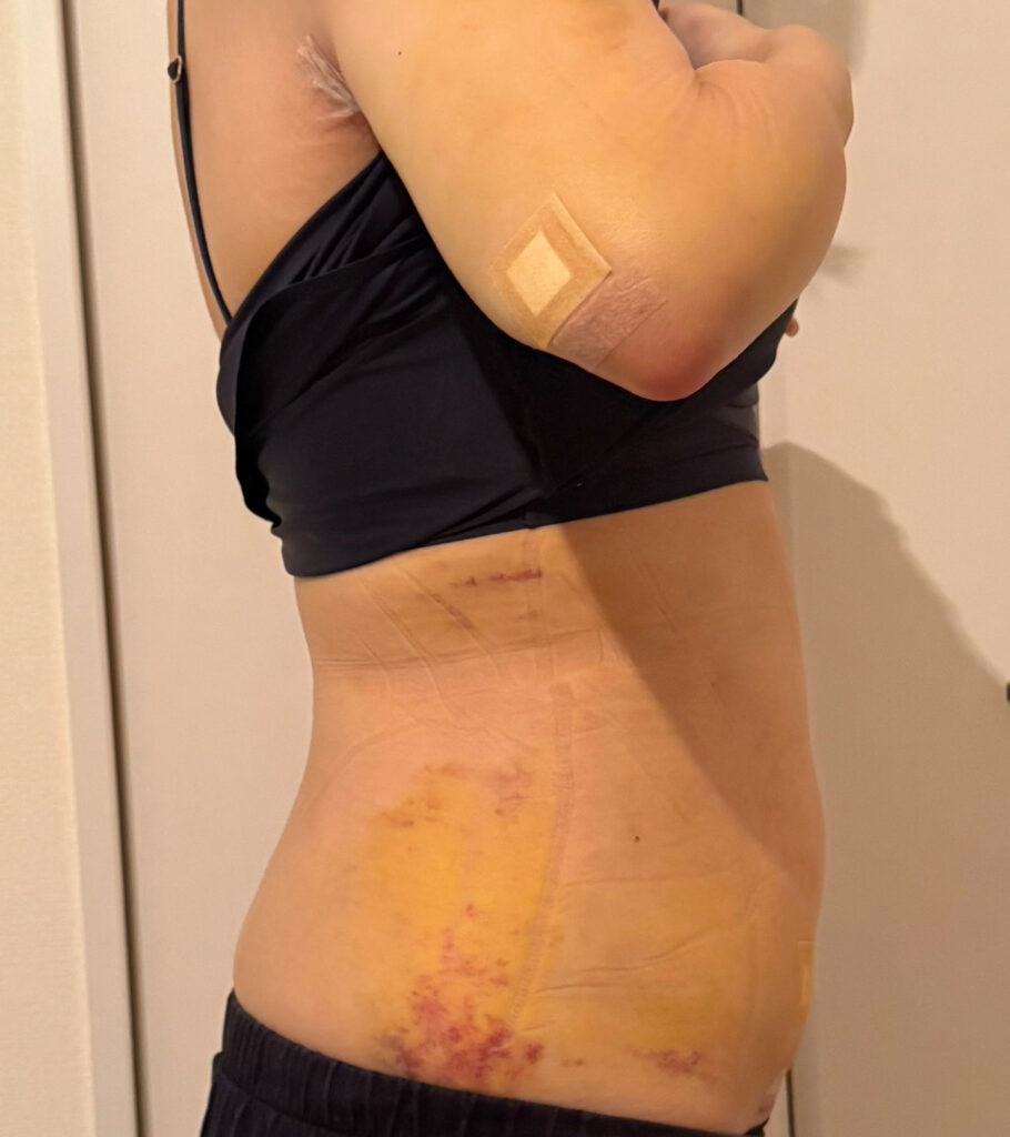 お腹の脂肪吸引