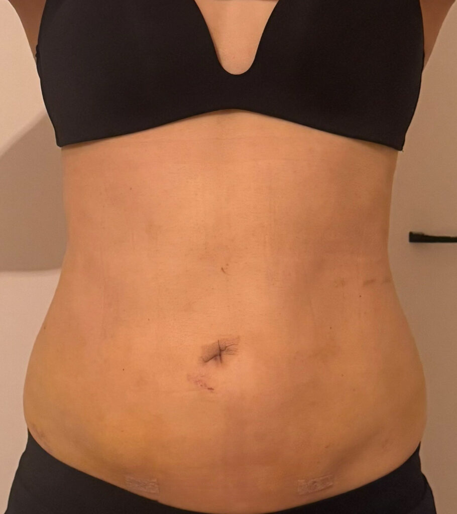 お腹の脂肪吸引