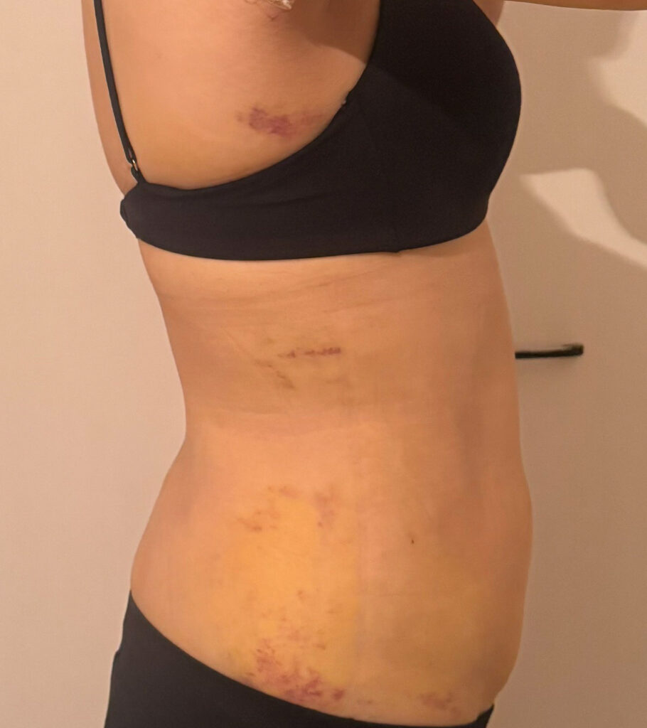 お腹の脂肪吸引