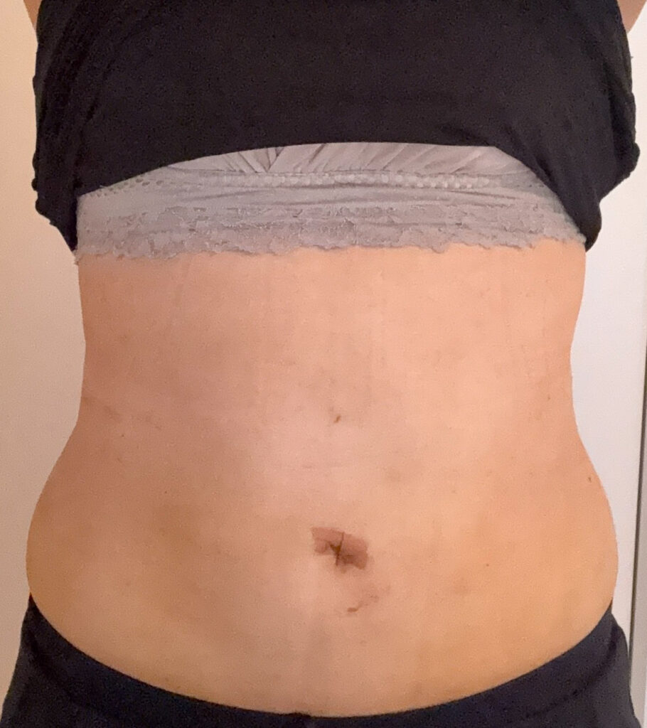 お腹の脂肪吸引