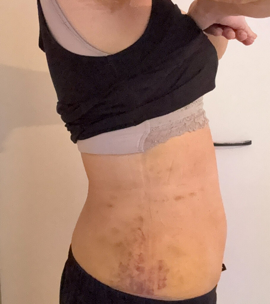 お腹の脂肪吸引