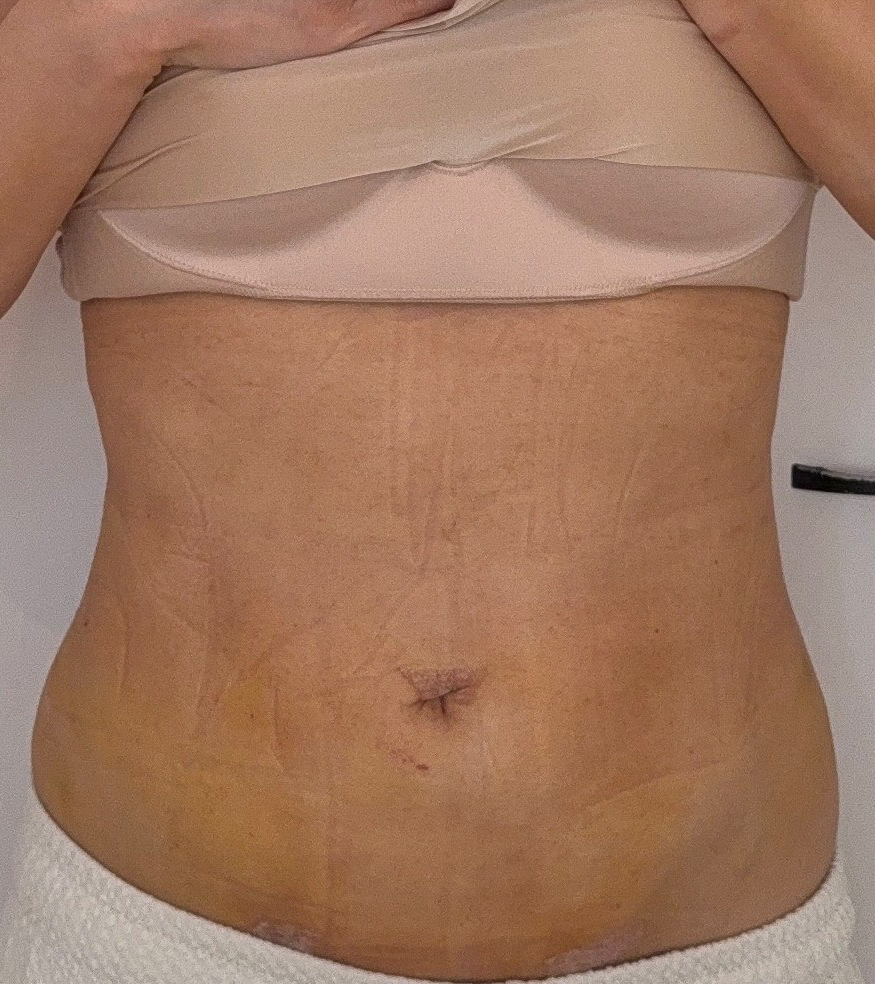 お腹の脂肪吸引