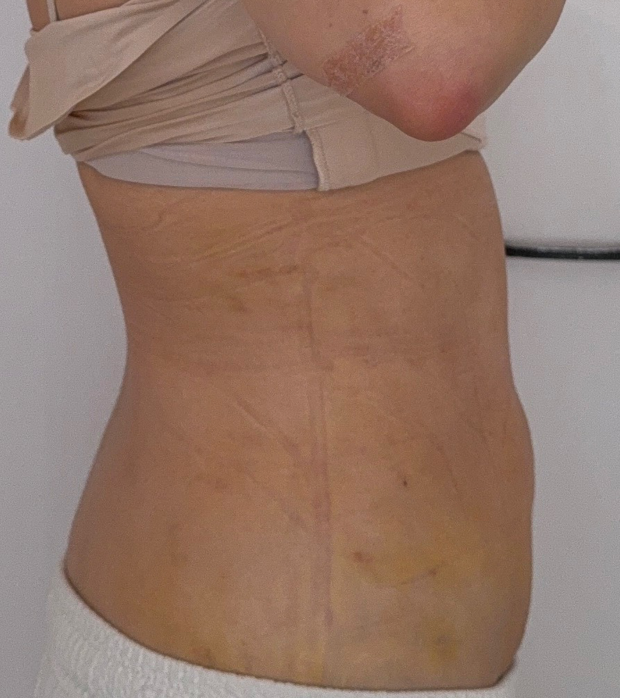 お腹の脂肪吸引