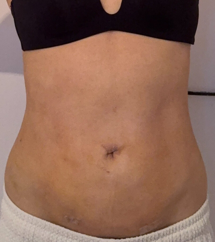 お腹の脂肪吸引