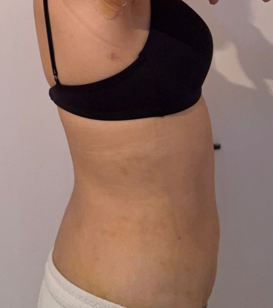 お腹の脂肪吸引