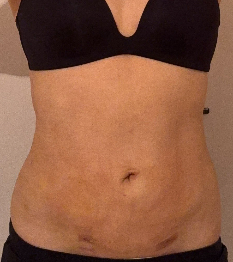 お腹の脂肪吸引