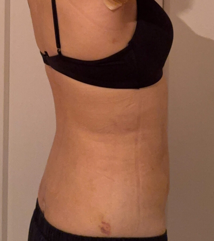 お腹の脂肪吸引